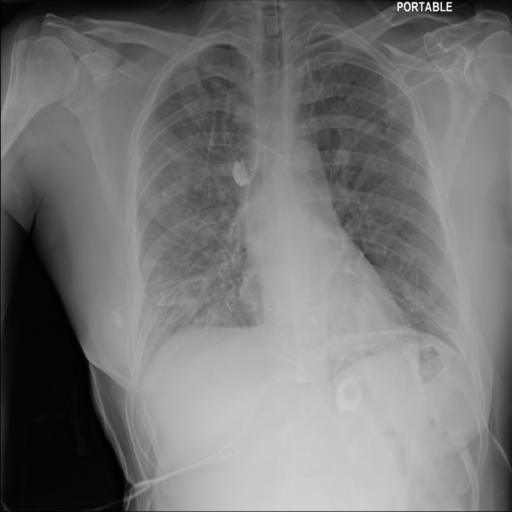 Synthetic CXR Example 01