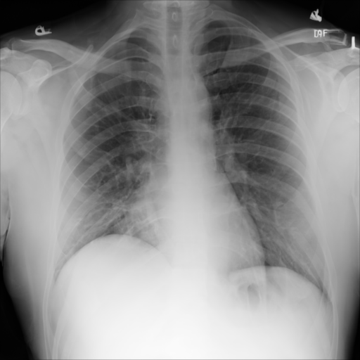 Synthetic CXR Example 03