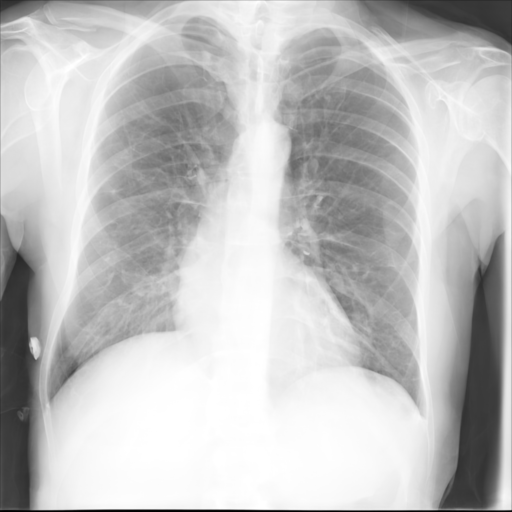 Synthetic CXR Example 04