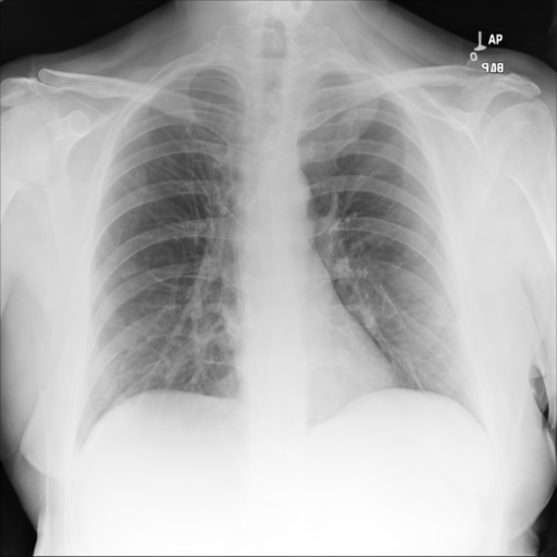 Synthetic CXR Example 02