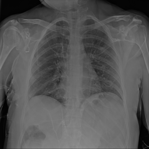 Synthetic CXR Example 05