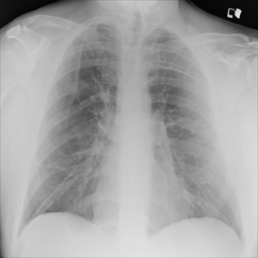 Synthetic CXR Example 06