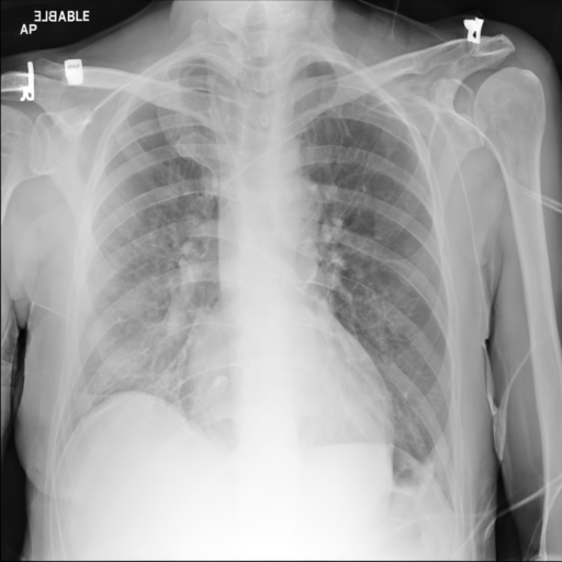 Synthetic CXR Example 07