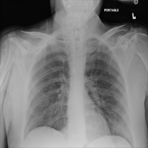 Synthetic CXR Example 09