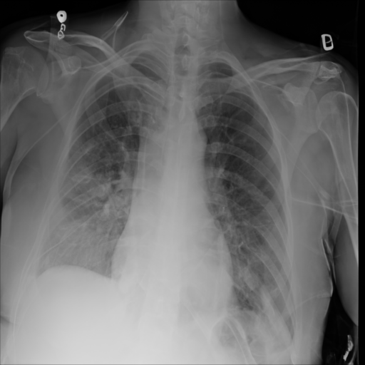 Synthetic CXR Example 08