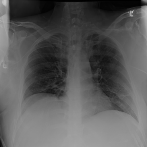 Synthetic CXR Example 10